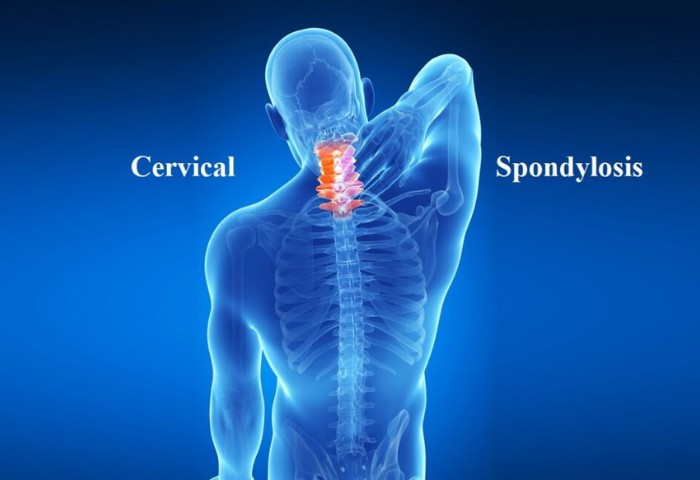 Cervical & Spondylitis