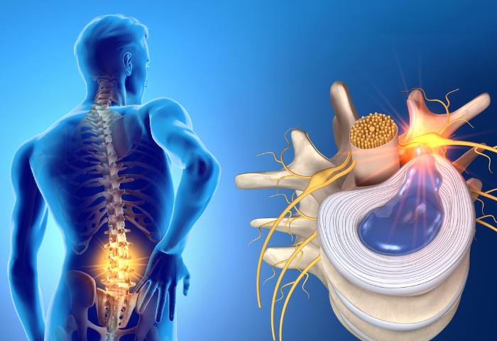 Sciatica / Slip Disc