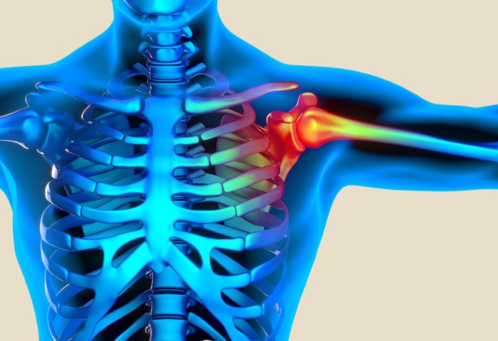 Frozen Shoulder