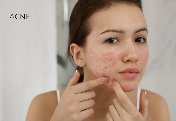 Skin Deseases